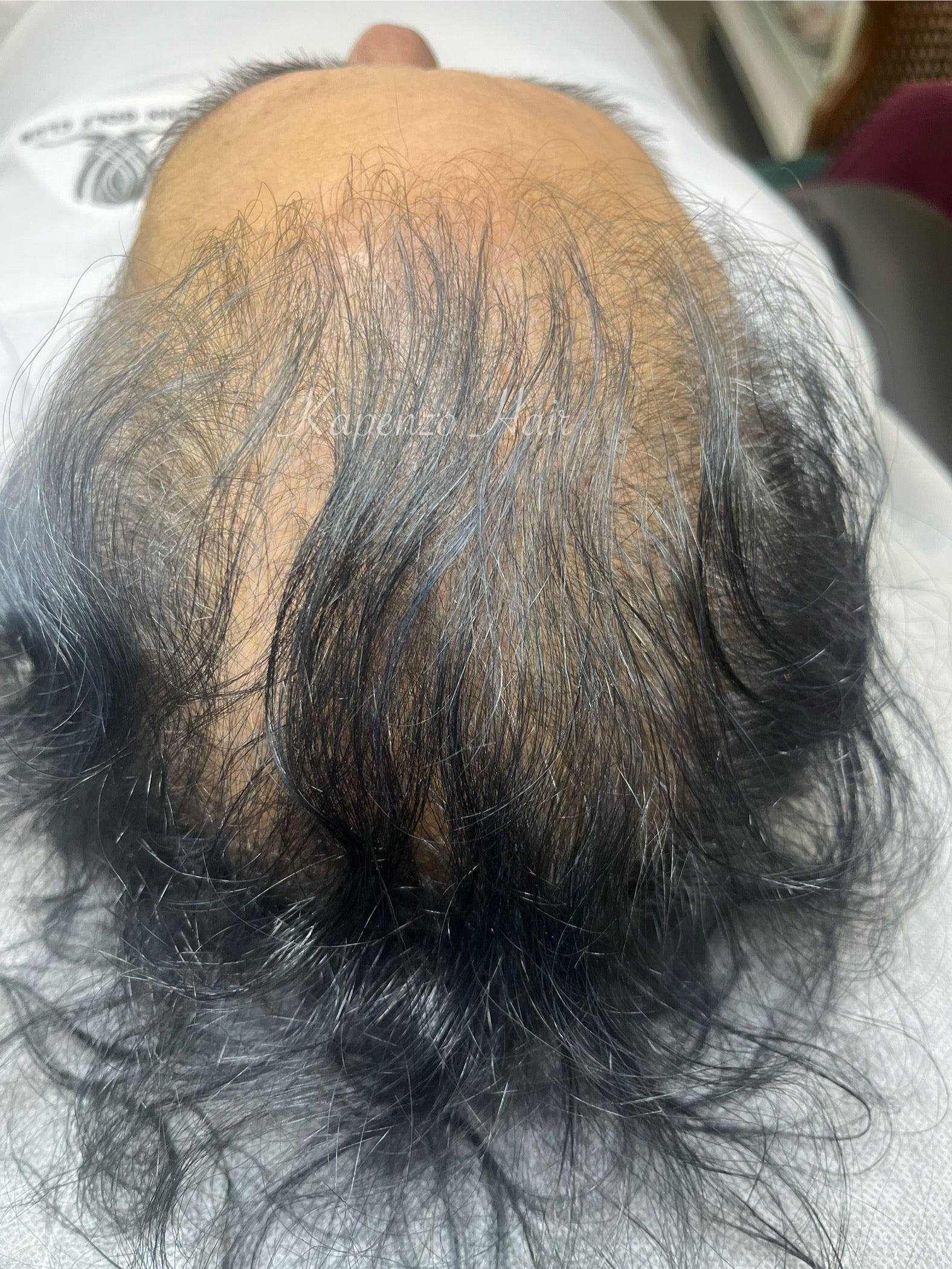 SCALP MICROPIGMENTATION KAPENZO HAIR